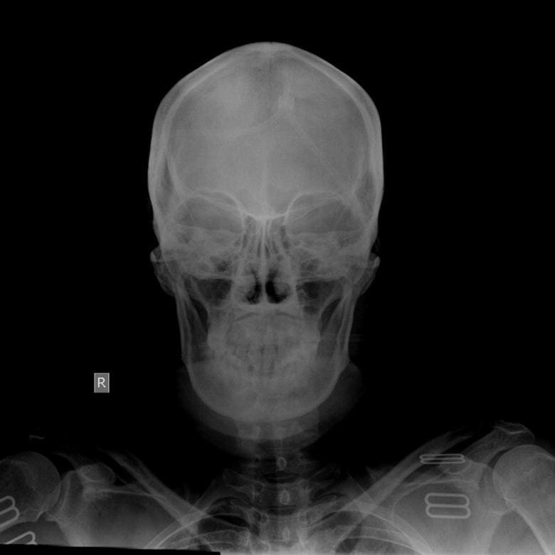 Рентген черепа снимок
